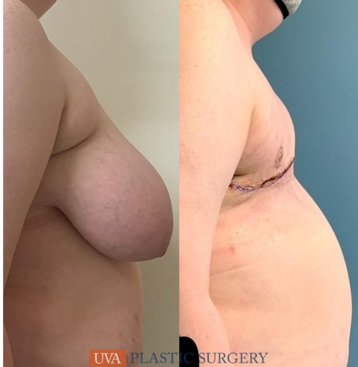 Chest Masculinization Case 232 Before & After Right Side | Richmond, Charlottesville & Roanoke, VA | University of Virginia Plastic Surgery