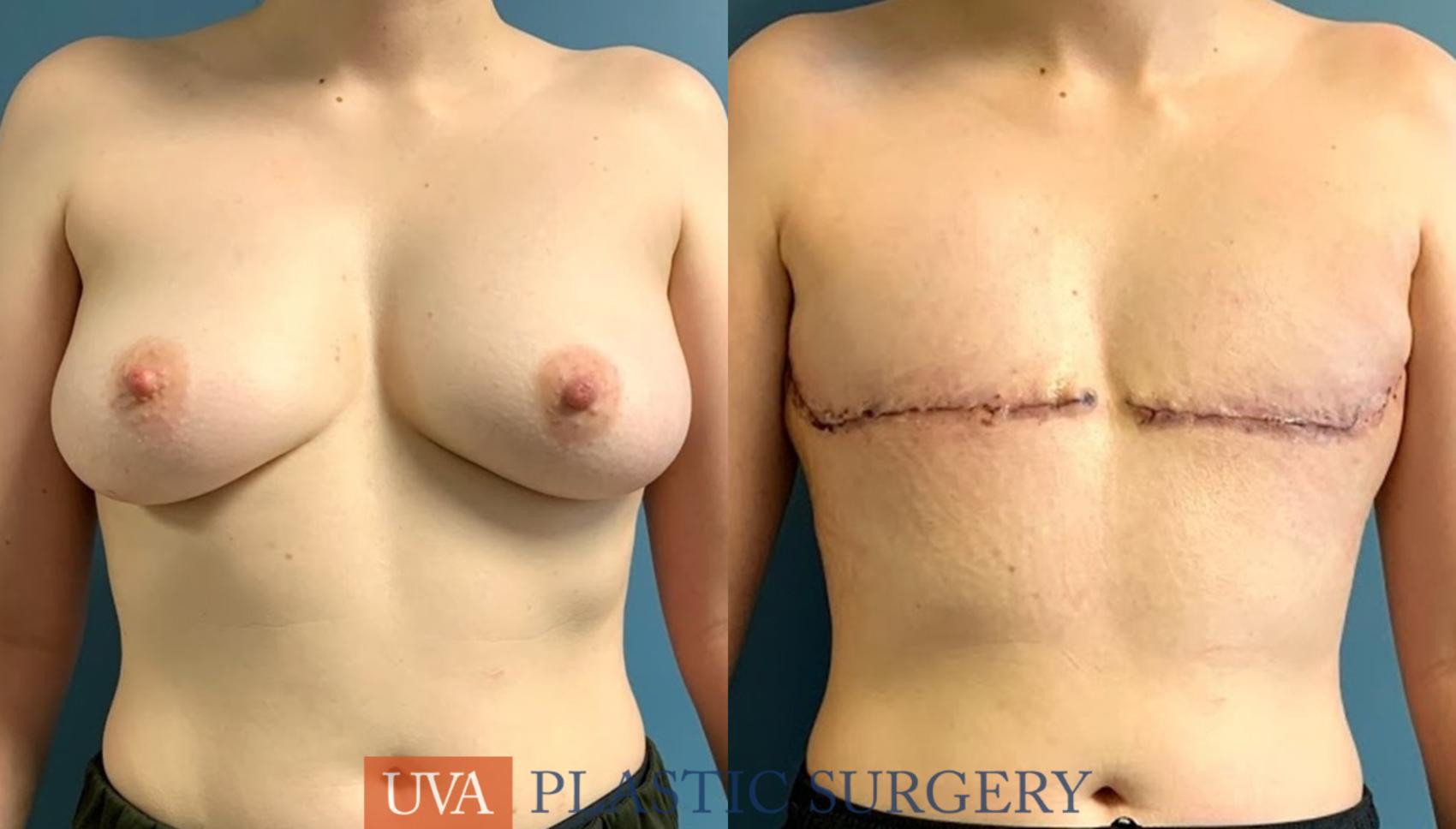 Chest Masculinization Case 233 Before & After Front | Charlottesville & Fishersville, VA | University of Virginia Plastic Surgery