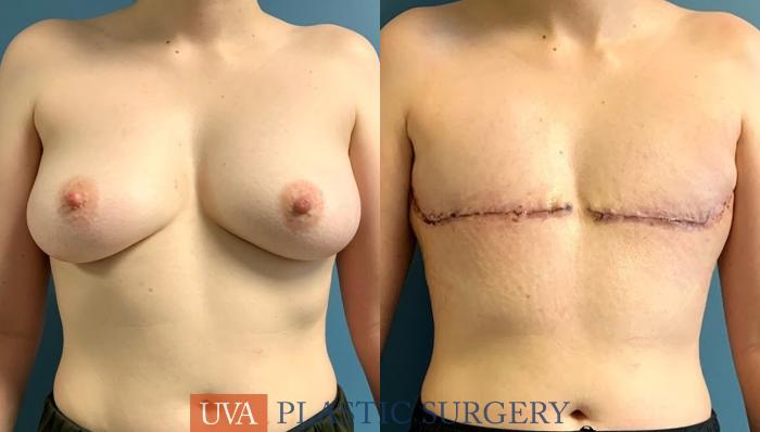 Chest Masculinization Case 233 Before & After Front | Richmond, Charlottesville & Roanoke, VA | University of Virginia Plastic Surgery