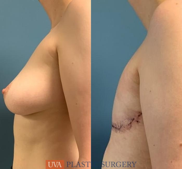 Chest Masculinization Case 233 Before & After Left Side | Richmond, Charlottesville & Roanoke, VA | University of Virginia Plastic Surgery