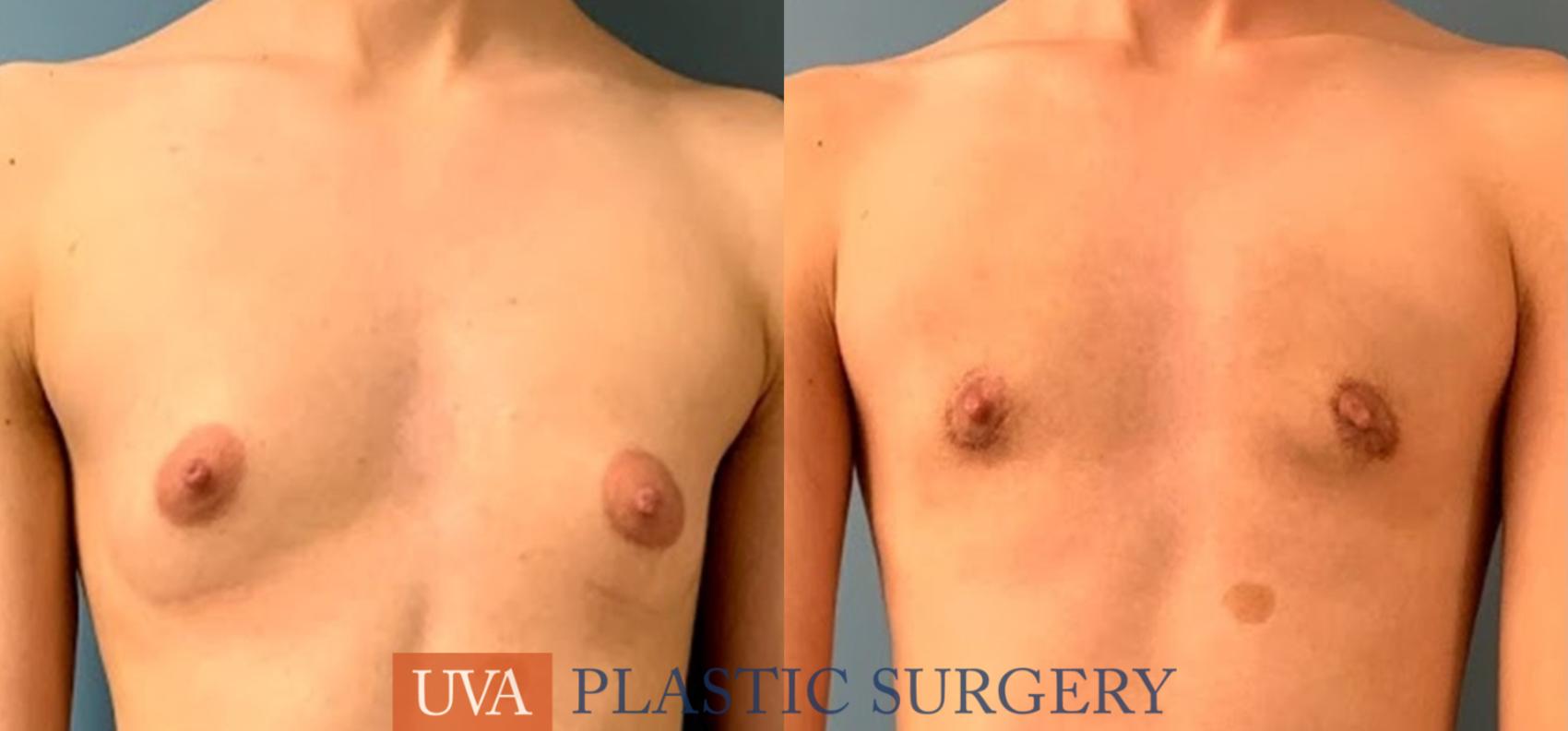 Chest Masculinization Case 234 Before & After Front | Charlottesville & Fishersville, VA | University of Virginia Plastic Surgery