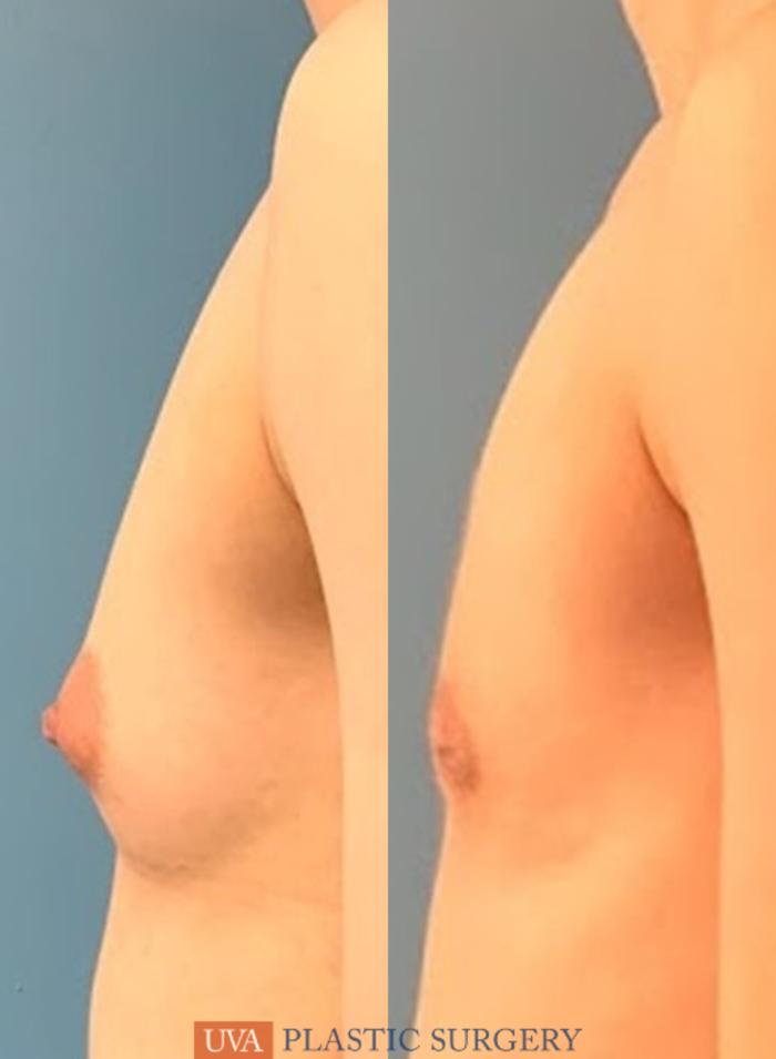 Chest Masculinization Case 234 Before & After Left Side | Richmond, Charlottesville & Roanoke, VA | University of Virginia Plastic Surgery