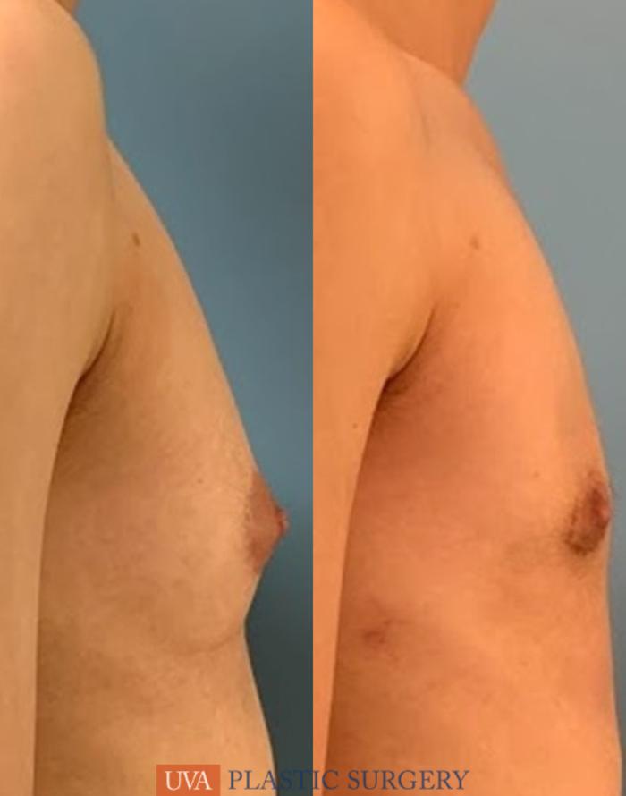 Chest Masculinization Case 234 Before & After Right Side | Richmond, Charlottesville & Roanoke, VA | University of Virginia Plastic Surgery