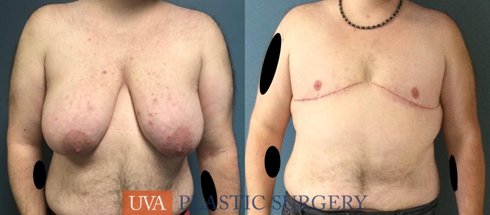 Chest Masculinization Case 237 Before & After Front | Richmond, Charlottesville & Roanoke, VA | University of Virginia Plastic Surgery