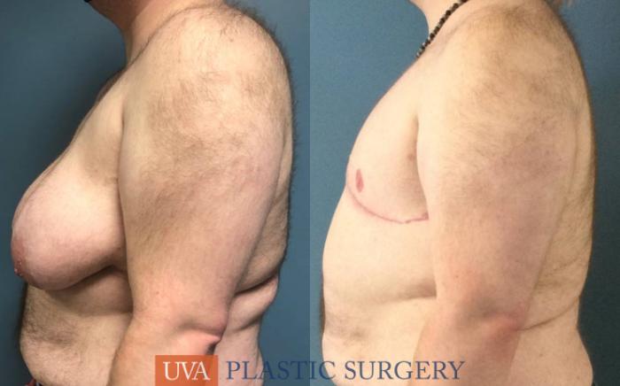 Chest Masculinization Case 237 Before & After Left Side | Richmond, Charlottesville & Roanoke, VA | University of Virginia Plastic Surgery
