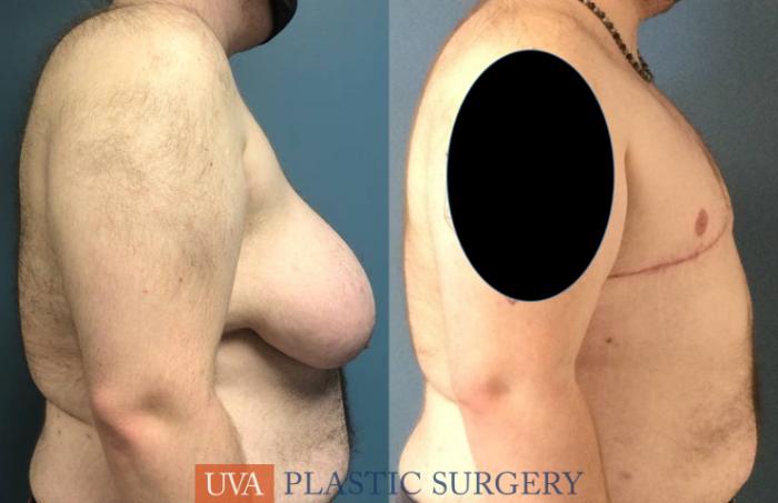 Chest Masculinization Case 237 Before & After Right Side | Richmond, Charlottesville & Roanoke, VA | University of Virginia Plastic Surgery