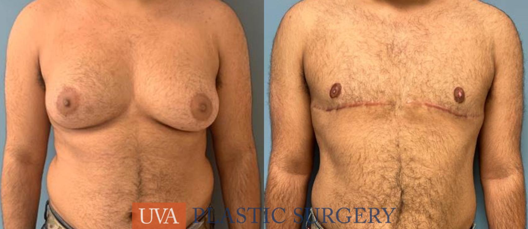 Chest Masculinization Case 238 Before & After Front | Charlottesville & Fishersville, VA | University of Virginia Plastic Surgery
