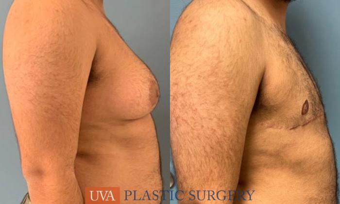 Chest Masculinization Case 238 Before & After Right Side | Richmond, Charlottesville & Roanoke, VA | University of Virginia Plastic Surgery