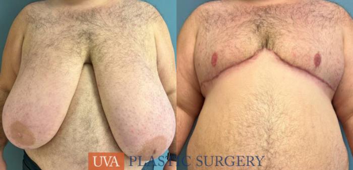 Chest Masculinization Case 240 Before & After Front | Richmond, Charlottesville & Roanoke, VA | University of Virginia Plastic Surgery