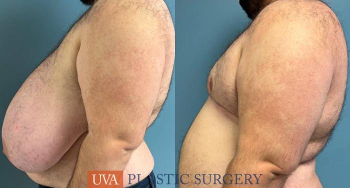 Chest Masculinization Case 240 Before & After Left Side | Richmond, Charlottesville & Roanoke, VA | University of Virginia Plastic Surgery