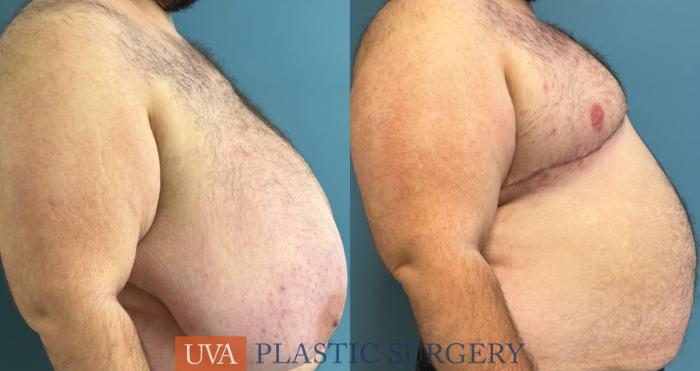 Chest Masculinization Case 240 Before & After Right Side | Richmond, Charlottesville & Roanoke, VA | University of Virginia Plastic Surgery