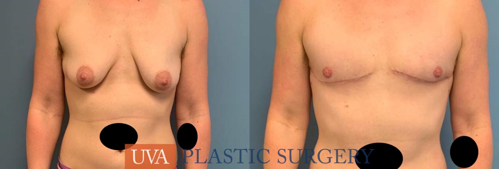 Chest Masculinization Case 243 Before & After Front | Charlottesville & Fishersville, VA | University of Virginia Plastic Surgery