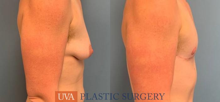 Chest Masculinization Case 243 Before & After Right Side | Richmond, Charlottesville & Roanoke, VA | University of Virginia Plastic Surgery