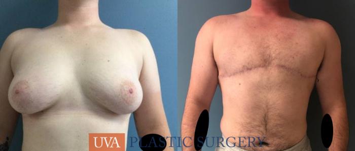 Chest Masculinization Case 244 Before & After Front | Charlottesville & Fishersville, VA | University of Virginia Plastic Surgery