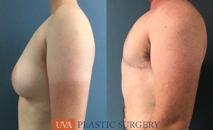 Chest Masculinization Case 244 Before & After Left Side | Richmond, Charlottesville & Roanoke, VA | University of Virginia Plastic Surgery