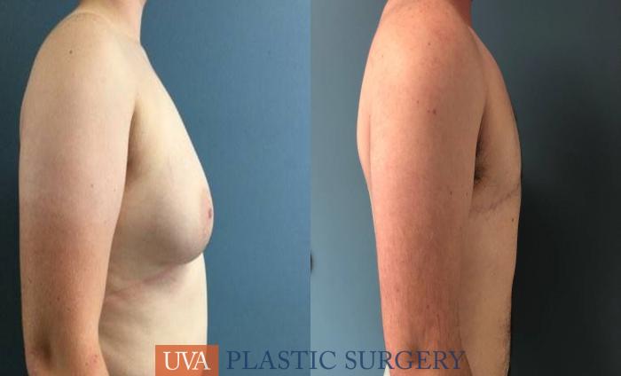 Chest Masculinization Case 244 Before & After Right Side | Richmond, Charlottesville & Roanoke, VA | University of Virginia Plastic Surgery