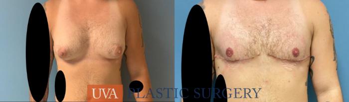 Chest Masculinization Case 245 Before & After Front | Charlottesville & Fishersville, VA | University of Virginia Plastic Surgery