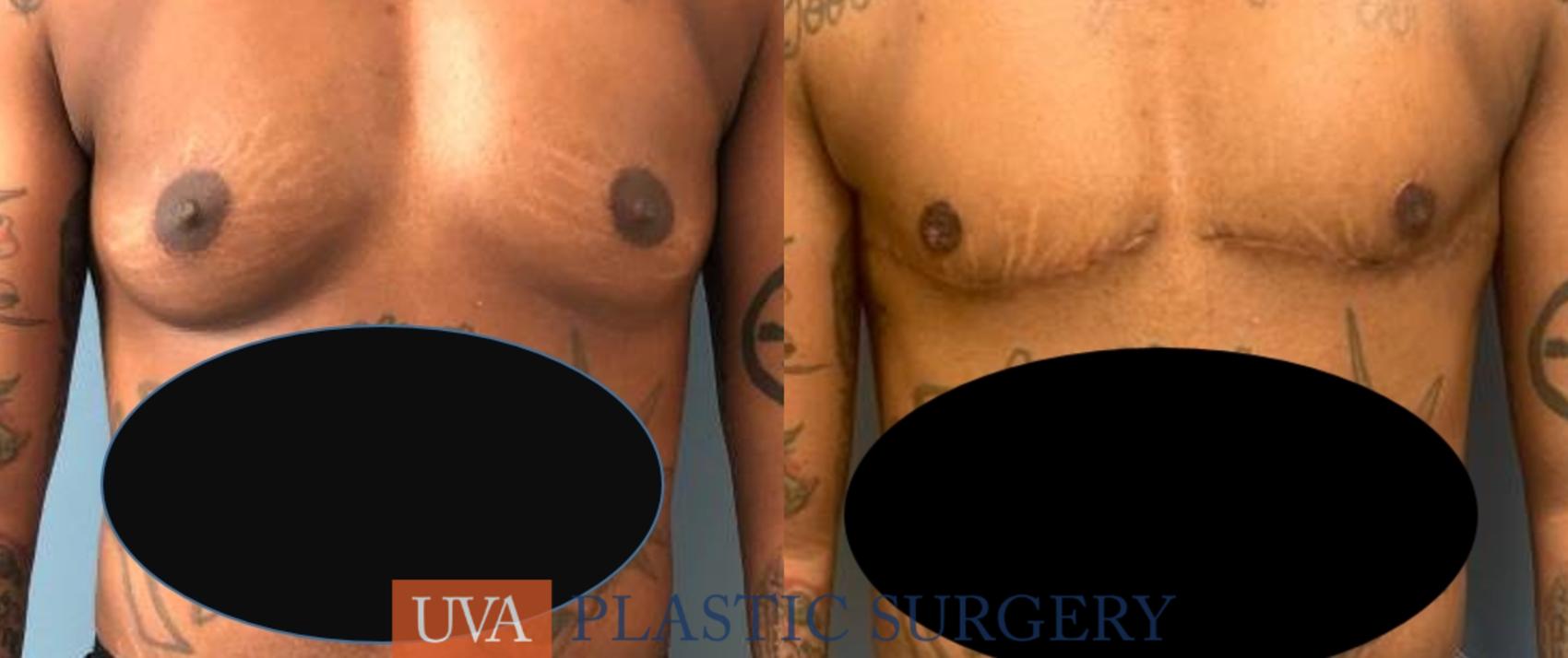 Chest Masculinization Case 246 Before & After Front | Charlottesville & Fishersville, VA | University of Virginia Plastic Surgery