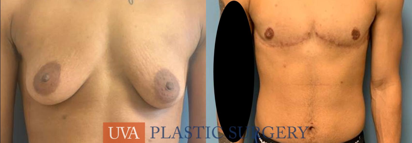Chest Masculinization Case 247 Before & After Front | Charlottesville & Fishersville, VA | University of Virginia Plastic Surgery