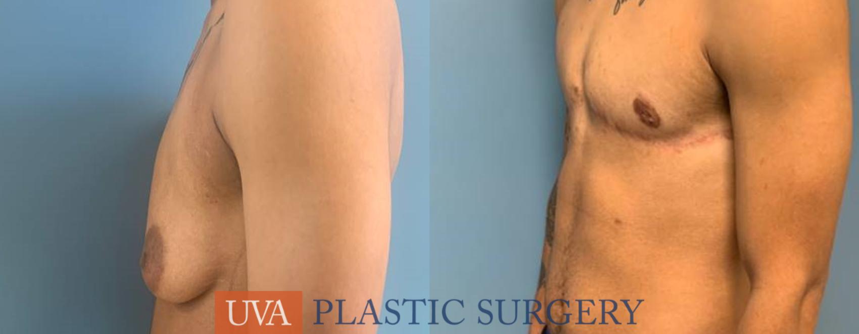 Chest Masculinization Case 247 Before & After Left Side | Richmond, Charlottesville & Roanoke, VA | University of Virginia Plastic Surgery