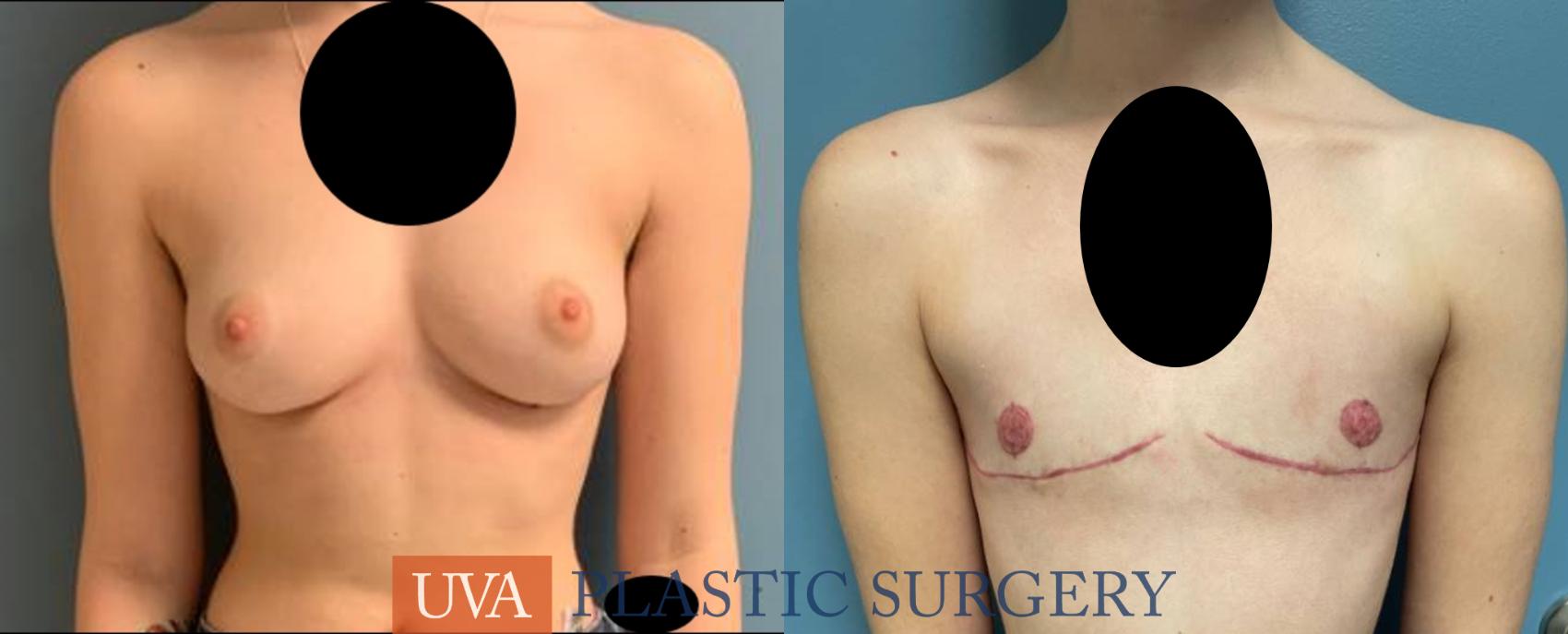 Chest Masculinization Case 248 Before & After Front | Charlottesville & Fishersville, VA | University of Virginia Plastic Surgery