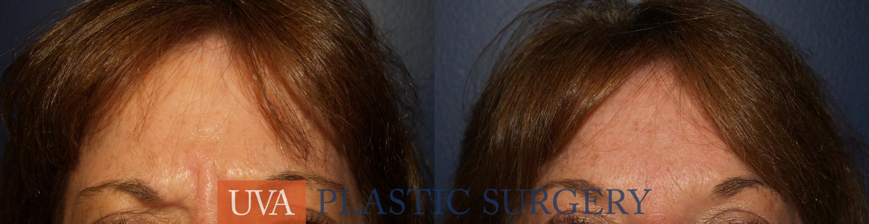 Dermal Fillers Case 17 Before & After View #1 | Richmond, Charlottesville & Roanoke, VA | University of Virginia Plastic Surgery