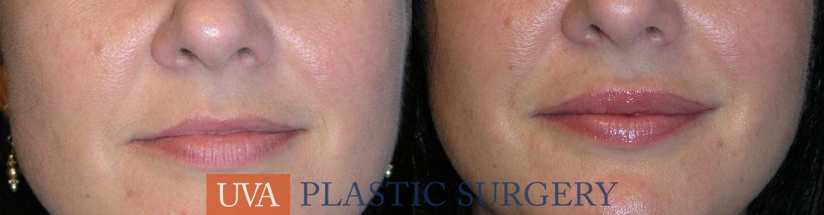 Dermal Fillers Case 18 Before & After View #1 | Charlottesville & Fishersville, VA | University of Virginia Plastic Surgery