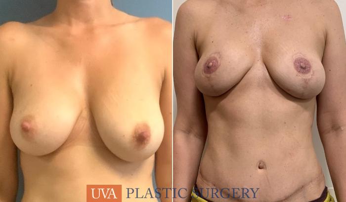 DIEP Flap Breast Reconstruction Case 223 Before & After Front | Richmond, Charlottesville & Roanoke, VA | University of Virginia Plastic Surgery