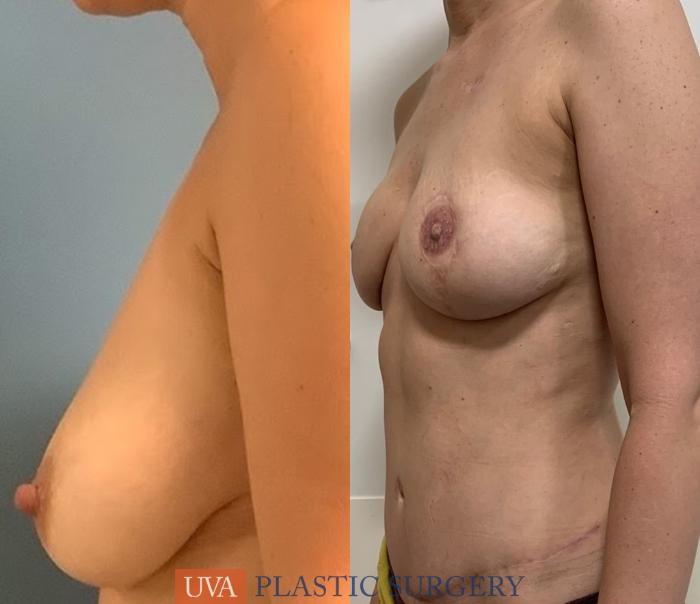 DIEP Flap Breast Reconstruction Case 223 Before & After Left Side | Richmond, Charlottesville & Roanoke, VA | University of Virginia Plastic Surgery
