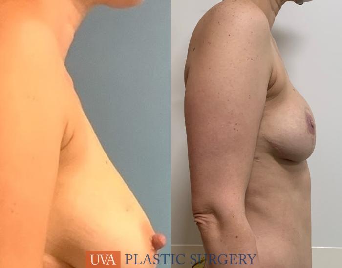 DIEP Flap Breast Reconstruction Case 223 Before & After Right Side | Richmond, Charlottesville & Roanoke, VA | University of Virginia Plastic Surgery