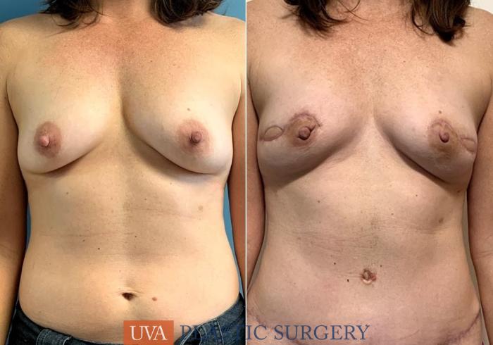DIEP Flap Breast Reconstruction Case 225 Before & After Front | Richmond, Charlottesville & Roanoke, VA | University of Virginia Plastic Surgery