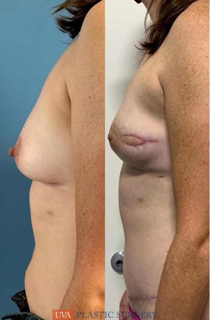 DIEP Flap Breast Reconstruction Case 225 Before & After Left Side | Richmond, Charlottesville & Roanoke, VA | University of Virginia Plastic Surgery