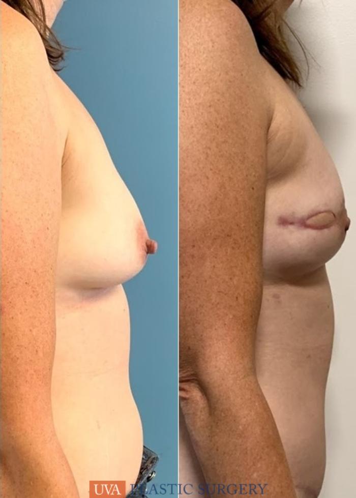 DIEP Flap Breast Reconstruction Case 225 Before & After Right Side | Richmond, Charlottesville & Roanoke, VA | University of Virginia Plastic Surgery