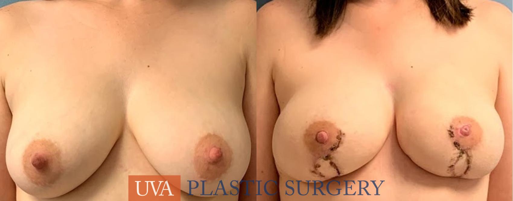 DIEP Flap Breast Reconstruction Case 226 Before & After Front | Charlottesville & Fishersville, VA | University of Virginia Plastic Surgery