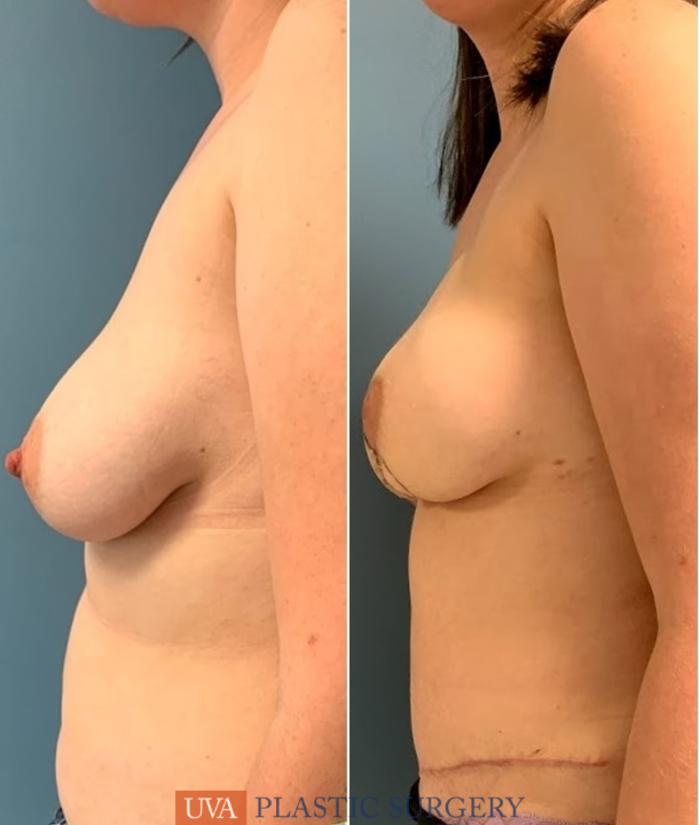 DIEP Flap Breast Reconstruction Case 226 Before & After Left Side | Richmond, Charlottesville & Roanoke, VA | University of Virginia Plastic Surgery