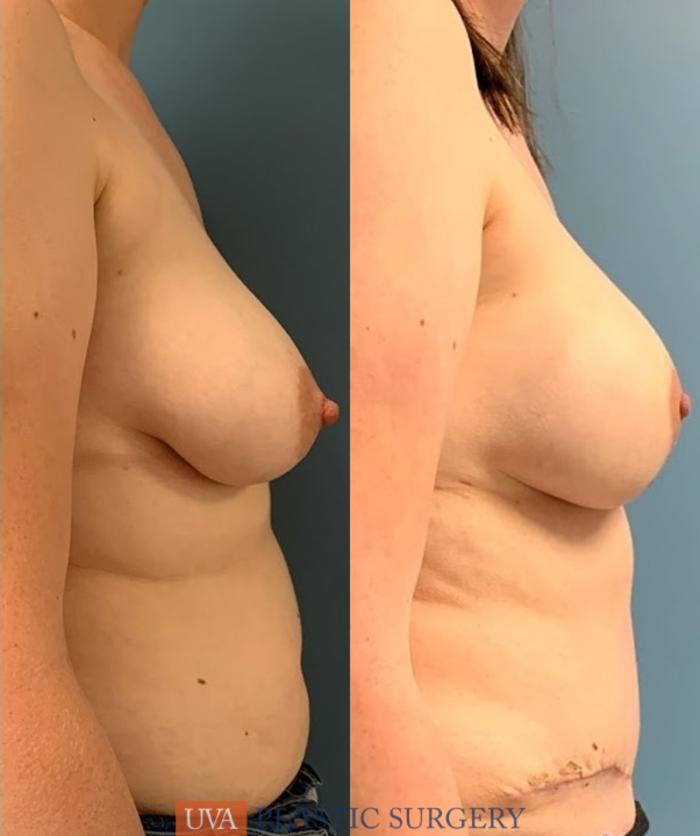 DIEP Flap Breast Reconstruction Case 226 Before & After Right Side | Richmond, Charlottesville & Roanoke, VA | University of Virginia Plastic Surgery