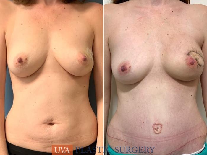 DIEP Flap Breast Reconstruction Case 227 Before & After Front | Richmond, Charlottesville & Roanoke, VA | University of Virginia Plastic Surgery