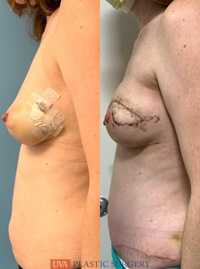 DIEP Flap Breast Reconstruction Case 227 Before & After Left Side | Richmond, Charlottesville & Roanoke, VA | University of Virginia Plastic Surgery