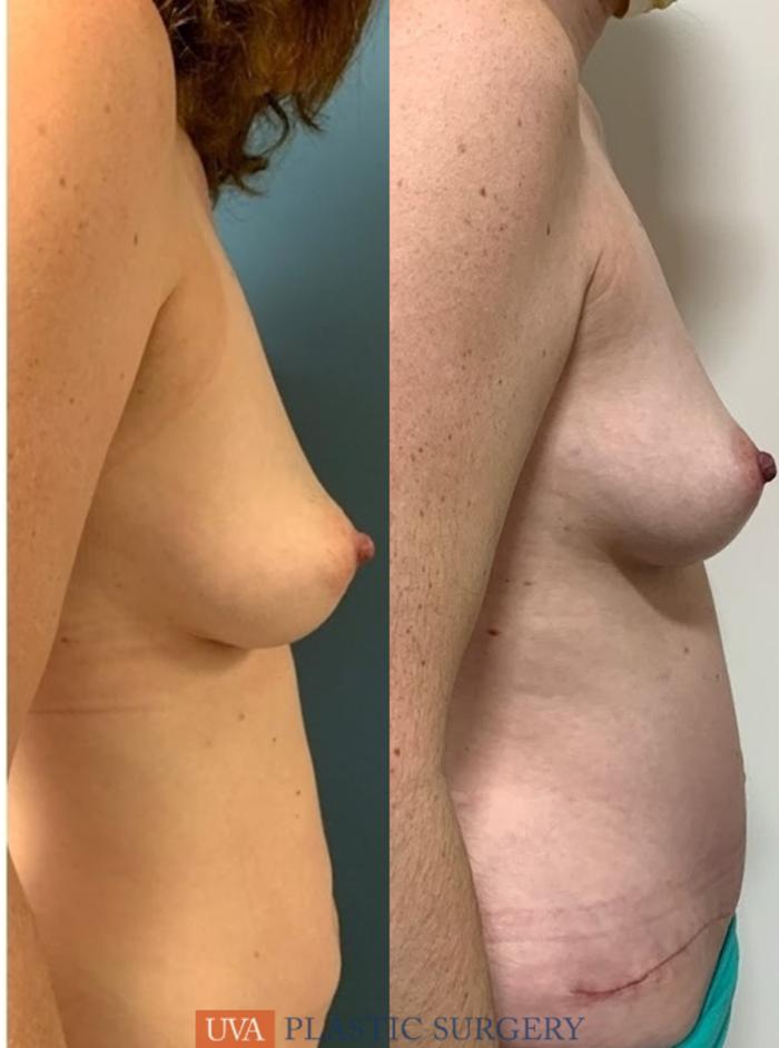 DIEP Flap Breast Reconstruction Case 227 Before & After Right Side | Richmond, Charlottesville & Roanoke, VA | University of Virginia Plastic Surgery