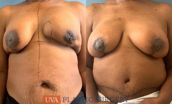 DIEP Flap Breast Reconstruction Case 228 Before & After Front | Richmond, Charlottesville & Roanoke, VA | University of Virginia Plastic Surgery