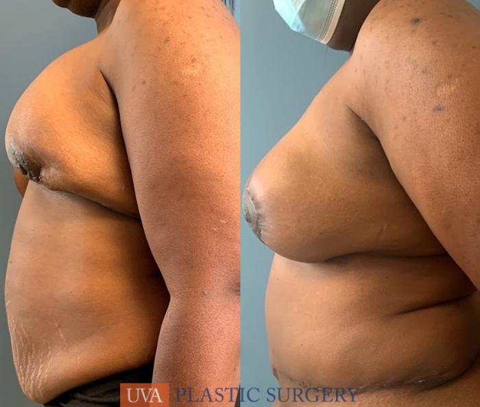 DIEP Flap Breast Reconstruction Case 228 Before & After Left Side | Richmond, Charlottesville & Roanoke, VA | University of Virginia Plastic Surgery