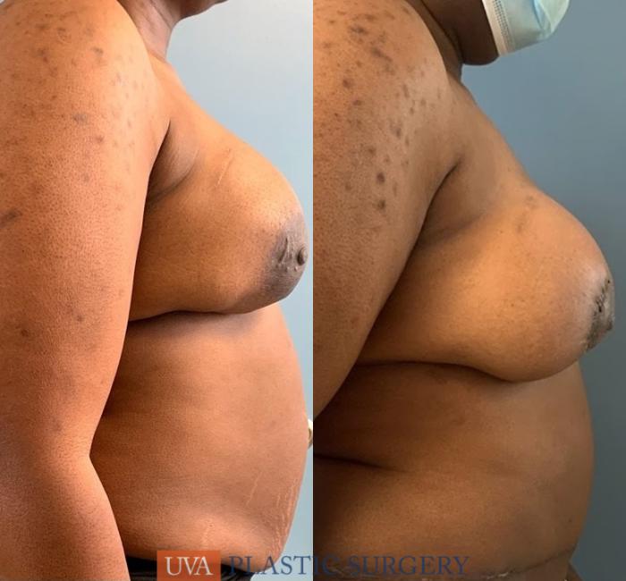 DIEP Flap Breast Reconstruction Case 228 Before & After Right Side | Richmond, Charlottesville & Roanoke, VA | University of Virginia Plastic Surgery
