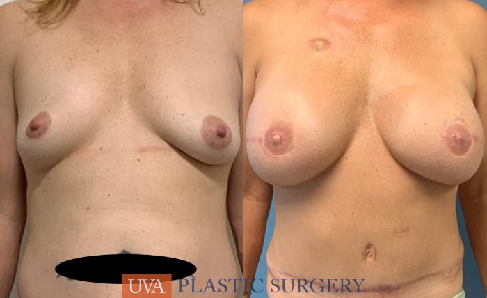DIEP Flap Breast Reconstruction Case 241 Before & After Front | Richmond, Charlottesville & Roanoke, VA | University of Virginia Plastic Surgery
