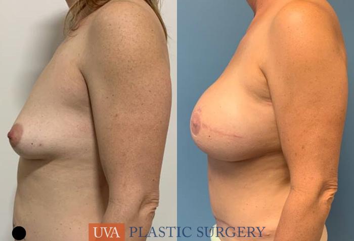 DIEP Flap Breast Reconstruction Case 241 Before & After Left Side | Richmond, Charlottesville & Roanoke, VA | University of Virginia Plastic Surgery