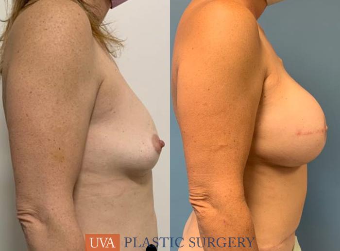 DIEP Flap Breast Reconstruction Case 241 Before & After Right Side | Richmond, Charlottesville & Roanoke, VA | University of Virginia Plastic Surgery