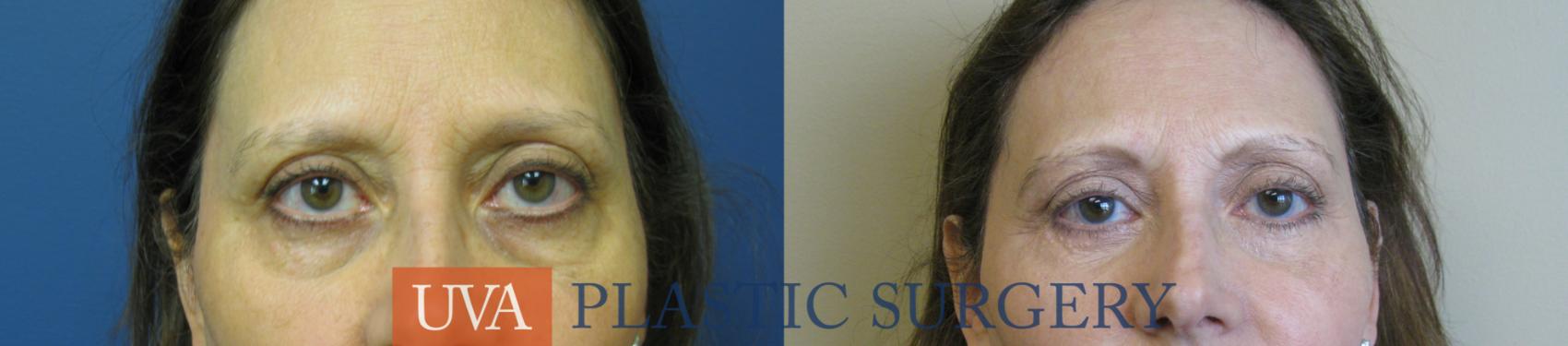 Eyelid Surgery (Blepharoplasty) Case 104 Before & After View #1 | Charlottesville & Fishersville, VA | University of Virginia Plastic Surgery