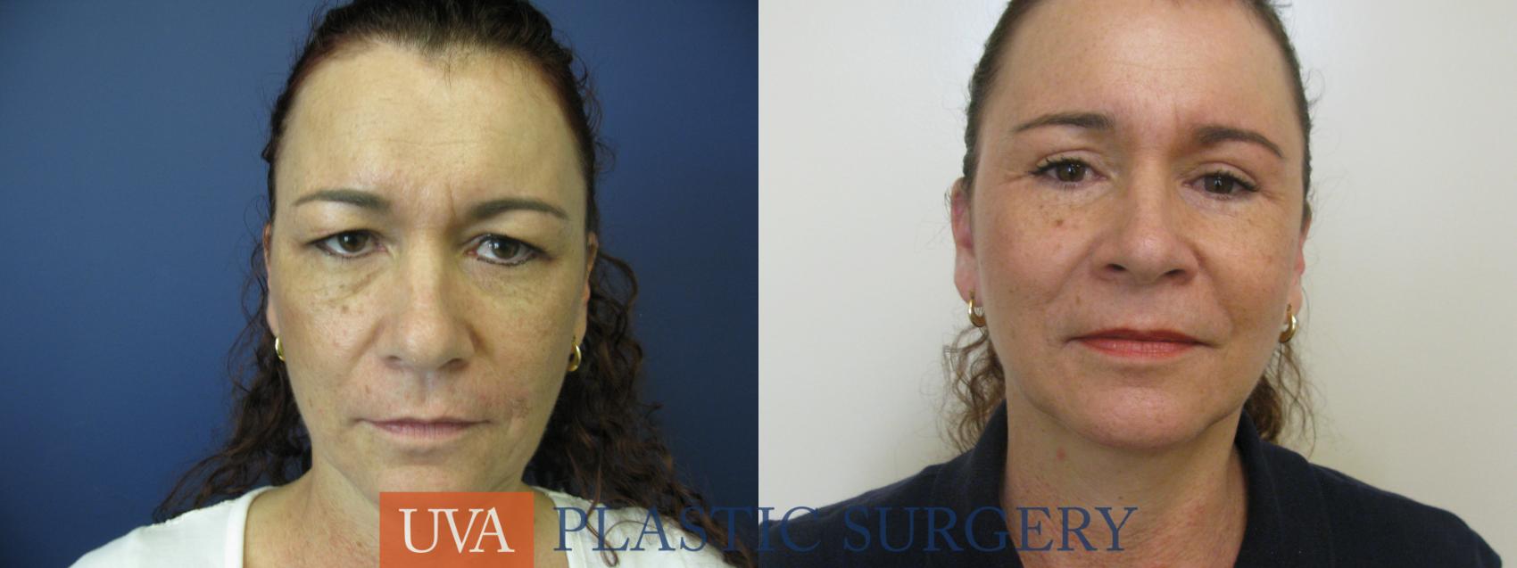 Eyelid Surgery (Blepharoplasty) Case 118 Before & After View #1 | Charlottesville & Fishersville, VA | University of Virginia Plastic Surgery