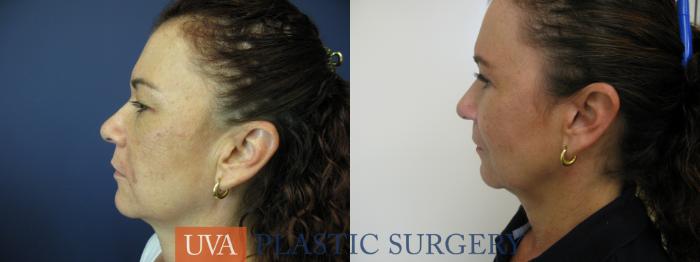 Eyelid Surgery (Blepharoplasty) Case 118 Before & After View #3 | Richmond, Charlottesville & Roanoke, VA | University of Virginia Plastic Surgery