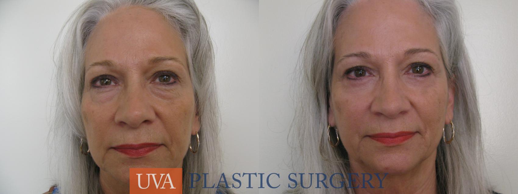 Eyelid Surgery (Blepharoplasty) Case 119 Before & After View #1 | Charlottesville & Fishersville, VA | University of Virginia Plastic Surgery