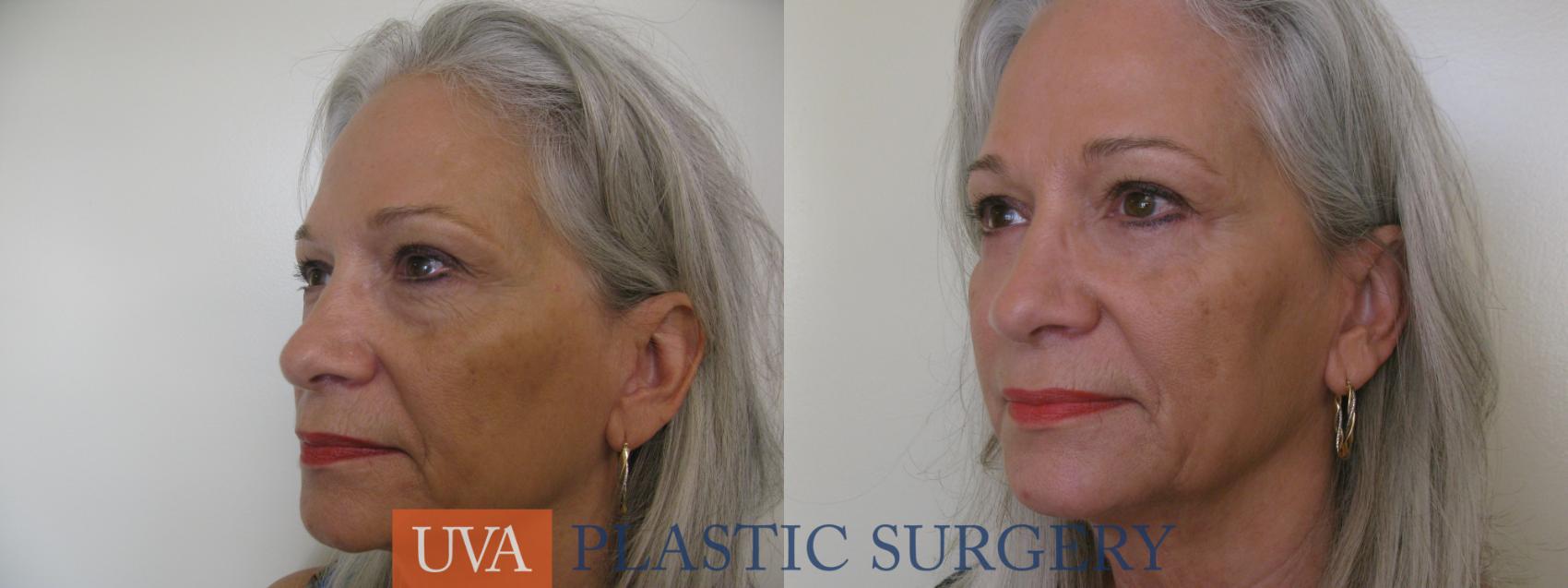 Eyelid Surgery (Blepharoplasty) Case 119 Before & After View #3 | Charlottesville & Fishersville, VA | University of Virginia Plastic Surgery
